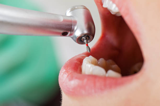 Best Emergency Dental Care for Abscessed Tooth in Greenville, NC
